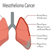 Mesothelioma