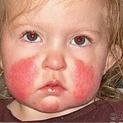 Slapped Cheek Syndrome