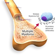 Multiple Myeloma