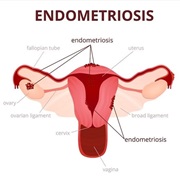 Endometriosis Awareness Month (March)