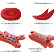 World Sickle Cell Day (June 19)