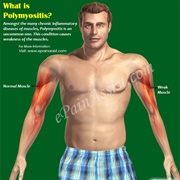 Polymyositis