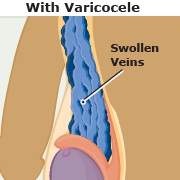 Vericocele