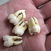 Wisdom Teeth Removed