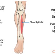 Shin Splint