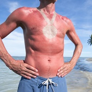 How to Avoid / Treat Sunburn