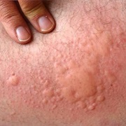 Hives