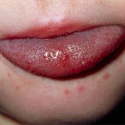 Hand, Foot and Mouth Disease