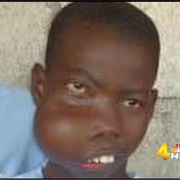 The Boy With a Tumor for a Face
