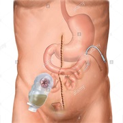 Ileostomy