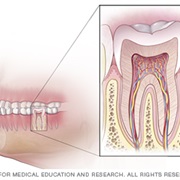 Root Canal