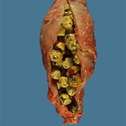 Gall Stones