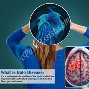 Baló Disease