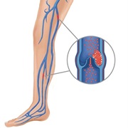 Deep Vein Thrombosis (DVT)