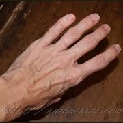 Cracking Knuckles Gives Arthritis