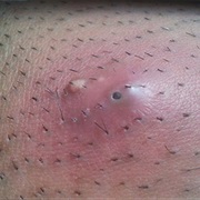 Ingrown Hair