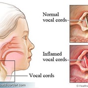 Laryngitis