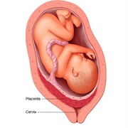 Placenta Previa
