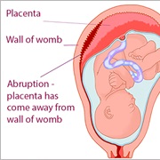 Placenta Abruption