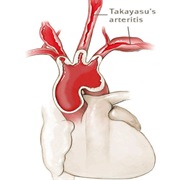 Takayasu's Arteritis