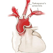 Takayasu&#39;s Arteritis