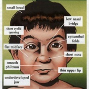 Fetal Alcohol Syndrome