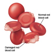 Hemolytic Anemia