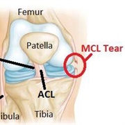 MCL Tear
