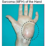 Sarcoma