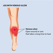 Venous Leg Ulcer