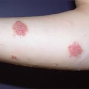 Discoid Eczema