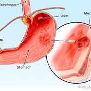 Stomach Ulcer