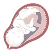 Pregnancy Complication