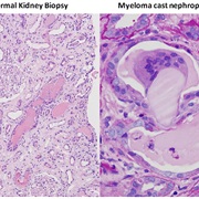 Myeloma Awareness Month (March)