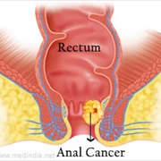 Anal Cancer