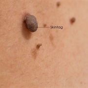 Skin Tag