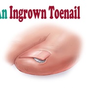 Ingrown Toenail