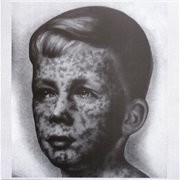 Ultra Eczema Various Artists - Fever