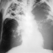 Tuberculosis Awareness Day (24 March)