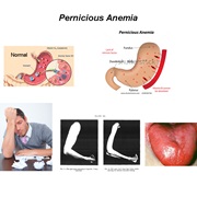 Pernicious Anemia (PA)