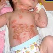 Impetigo