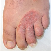 Athletes Foot