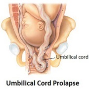 Umbilical Cord Prolapse