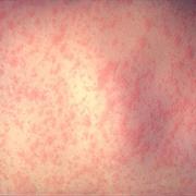 Rubella