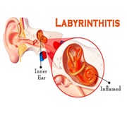 Labyrinthitis