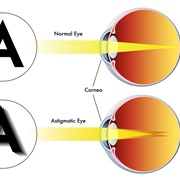 Astigmatism
