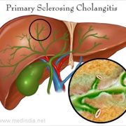 Primary Sclerosing Cholangitis