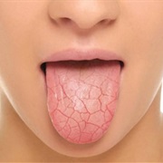 Dry Mouth