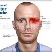 Cluster Headache