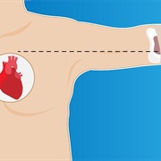 Treat a Bullet/Knife Wound